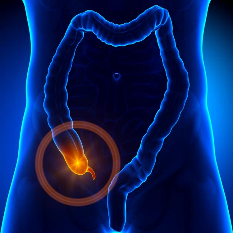 Apendicita dă dureri abdominale severe FOTO 123 RF