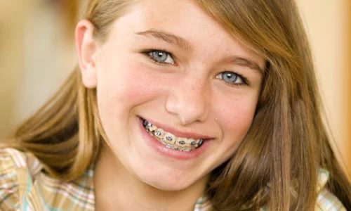 fata aparat dentar fotolia 10421549  jpeg