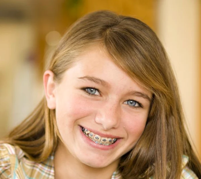 
    Aparatul dentar fix este recomandat copiilor mai mari de 12 ani   