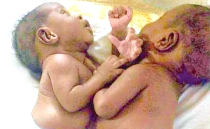 Copiii au fost despărţiţi după o intervenţie chirurgicală de patru ore şi jumătate