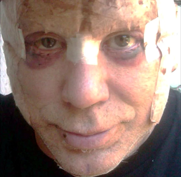 Mickey Rourke, după operaţia estetică ratată