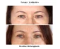 rezultat blefaroplastie iancu morad luxury aesthetics 3 jpg