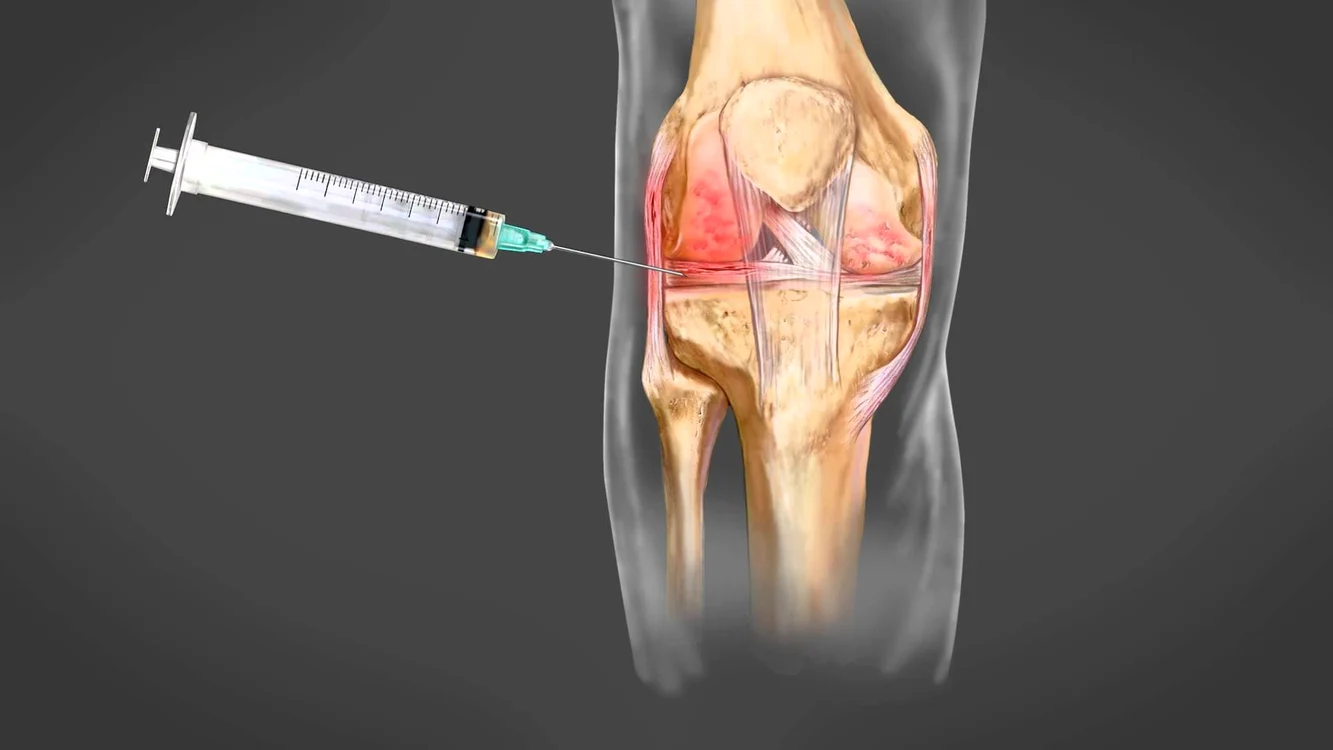 Terapia PRP implică o injecţie cu plasma trombocitară recoltată din sângele pacientului