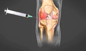 Terapia PRP implică o injecţie cu plasma trombocitară recoltată din sângele pacientului jpeg