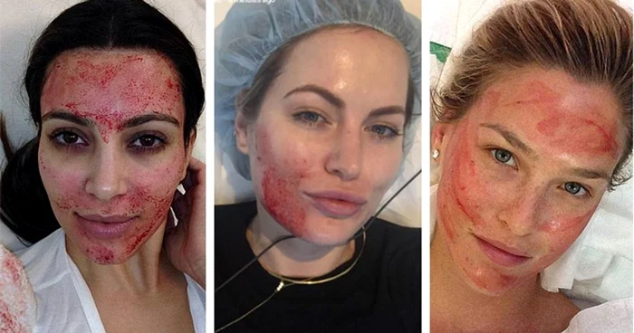 Kim Kardashian, Bar Refaeli şi Keira Maguire sunt câteva dintre starurile care au apelat la terapia Dracula