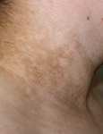 Acanthosis nigricans jpg