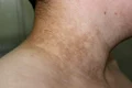 Acanthosis nigricans jpg