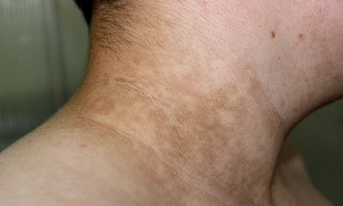 Acanthosis nigricans jpg