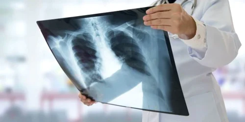 cancer plamani webp