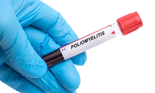 Poliomielita FOTO Shutterstock