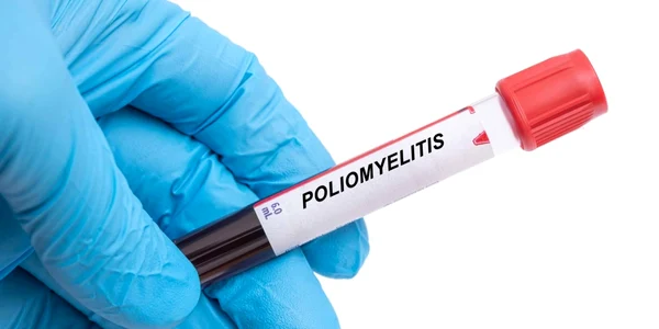 Poliomielita FOTO Shutterstock