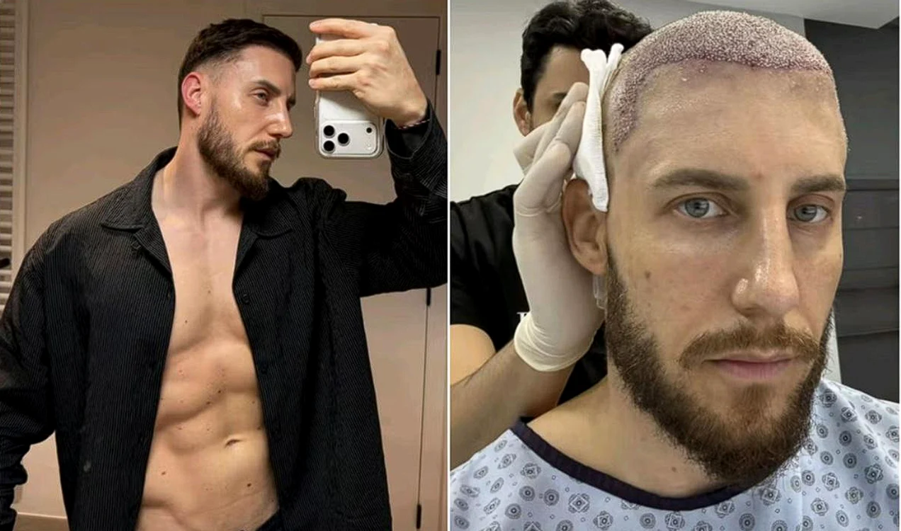 Un bărbat a încercat să își facă transplant de păr/sursă foto: social media