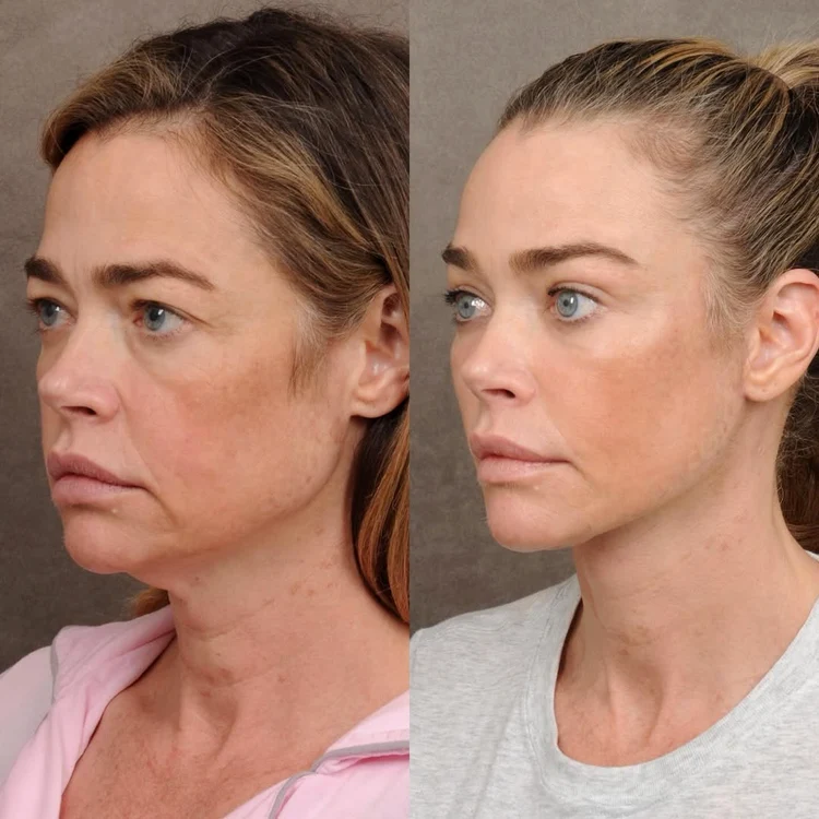 Denise Richards lifting, Foto Instagram (8) jpg