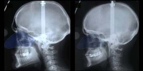 Comparaţie dimensiuni nas femei barbati FOTO UI College of Dentistry