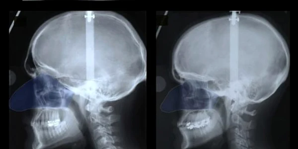 Comparaţie dimensiuni nas femei barbati FOTO UI College of Dentistry
