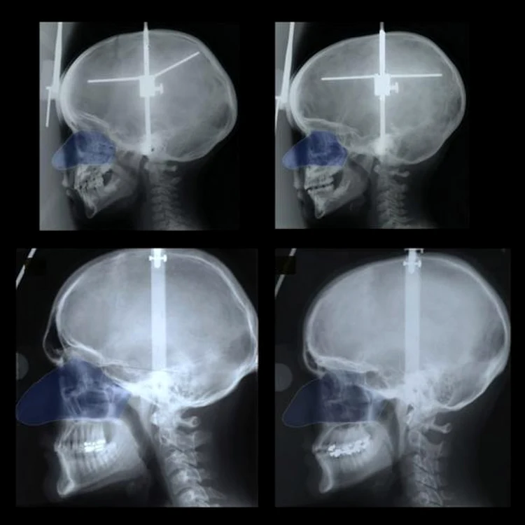 Comparaţie dimensiuni nas femei barbati FOTO UI College of Dentistry
