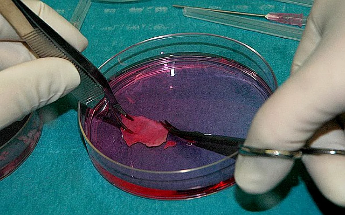 O parte din ţesutul ovarian extirpat într-un vas petri, înainte de a fi congelat.