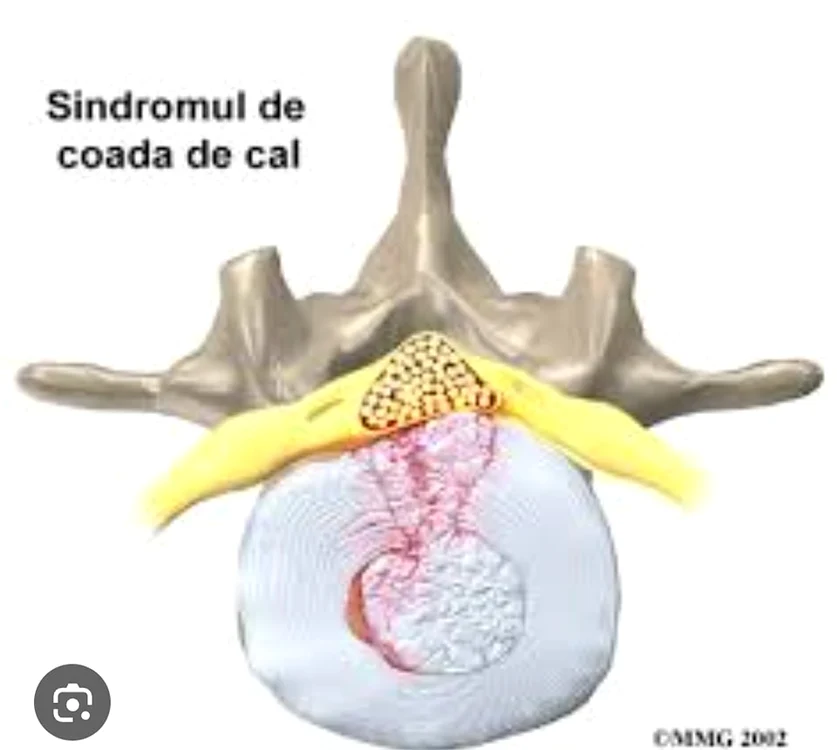 Sindromul de coadă de cal  FOTO Facebook Răzvan Darea 