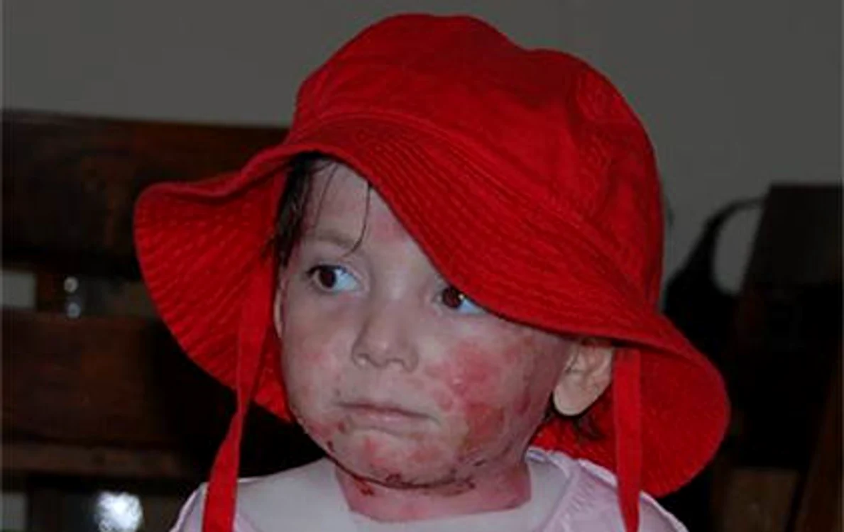 
    Fetiţa nu se va vindeca niciodată complet de boala de care suferă  