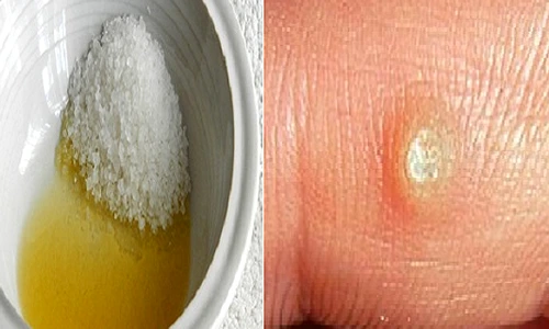 1 care sunt tratamentele naturale care te scapa de negi in cel mai scurt timp kcqr png png