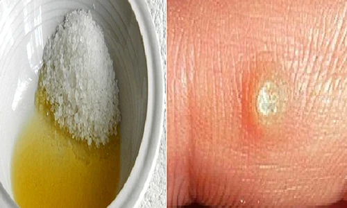 1 care sunt tratamentele naturale care te scapa de negi in cel mai scurt timp kcqr png png