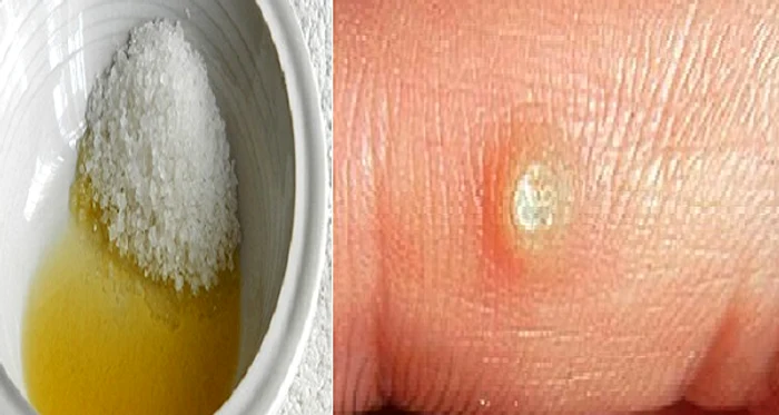 1 care sunt tratamentele naturale care te scapa de negi in cel mai scurt timp kcqr png png