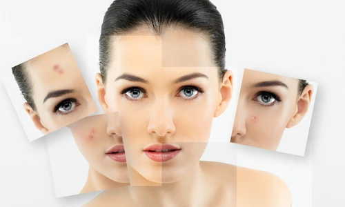 Dieta pentru acnee şi coşuri  Ce alimente te ajută să scapi de aceasta problemă jpeg