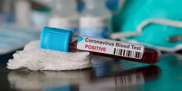 Coronavirus - test pozitiv FOTO Shutterstock