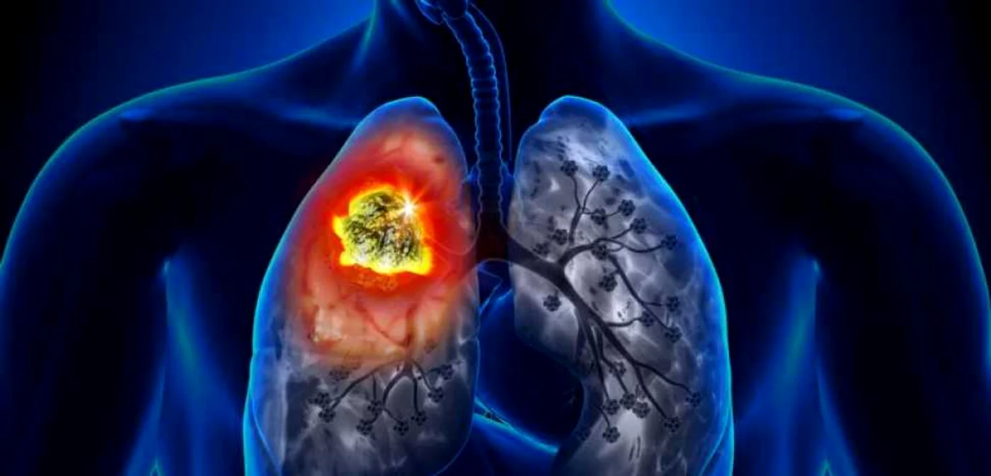 Fibroza pulmonară este la fel de gravă ca şi cancerul