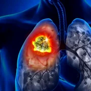 cancer pulmonar