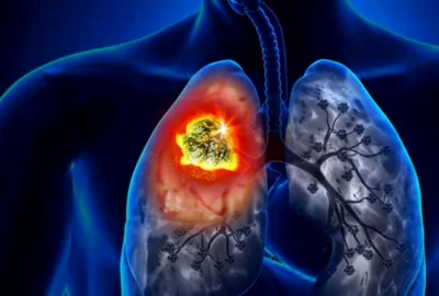 cancer pulmonar