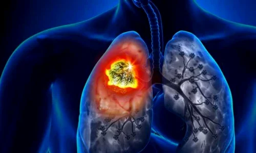 cancer pulmonar