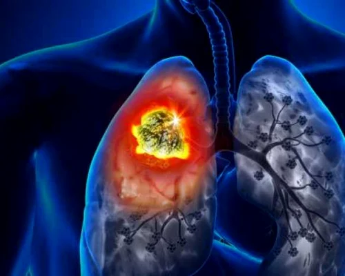 cancer pulmonar