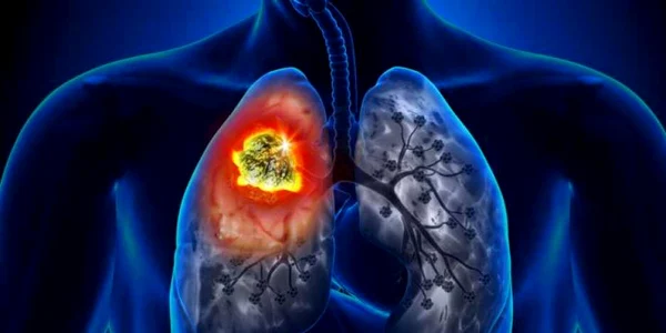 cancer pulmonar
