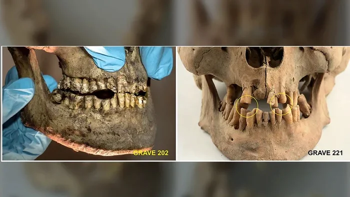 Mai mulți vânători de balene aveau urme de uzură a dinților (© Loktu, Brødholt, 2026, PLOS One; CC-B