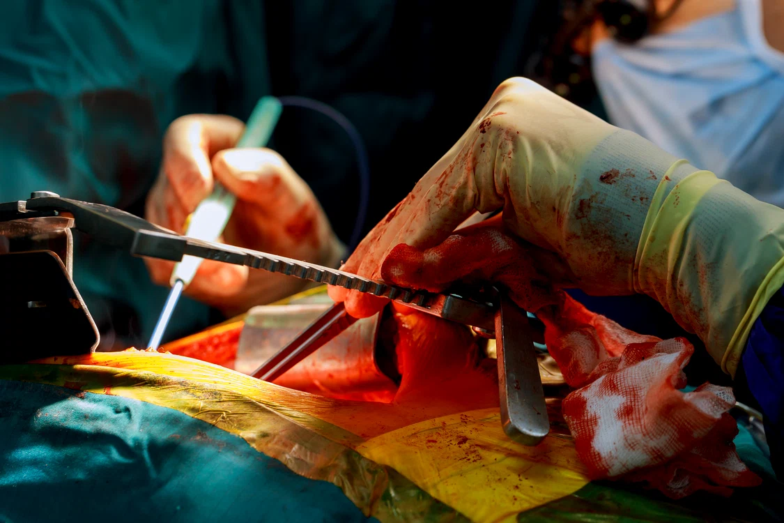 transplant ficat 88532204 xxl jpeg