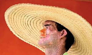 Djalma Jardin şi a  pierdut un ochi, nasul  şi buza superioară  din cauza soarelui jpeg