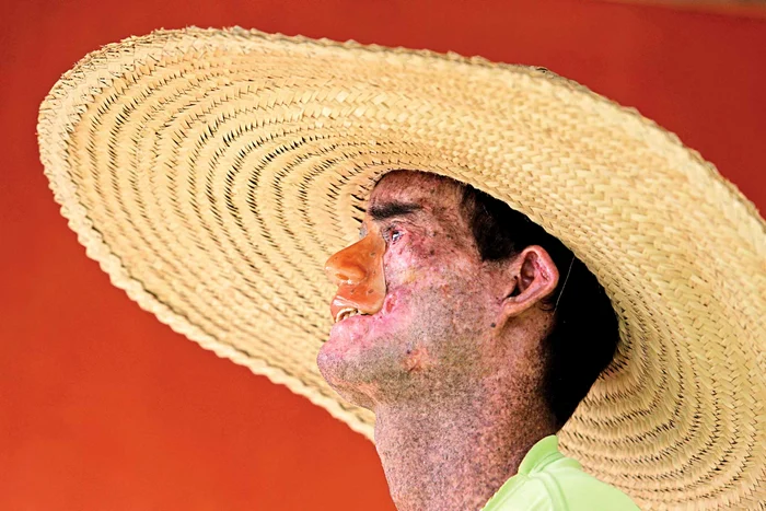 Djalma Jardin şi-a  pierdut un ochi, nasul  şi buza superioară  din cauza soarelui