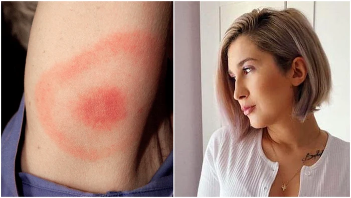 Ce este Borelioza, boala cumplită care a făcut-o pe Adda să se retragă din showbiz