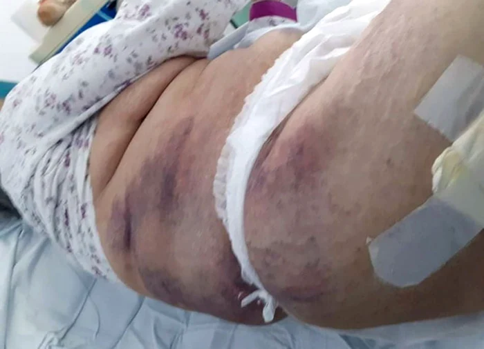Pacienta a fost găsită cu multiple vânătăi pe corp Foto: gorjonline.ro