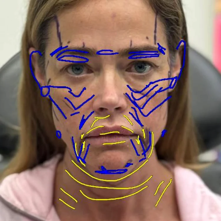 Denise Richards lifting, Foto Instagram (2) jpg