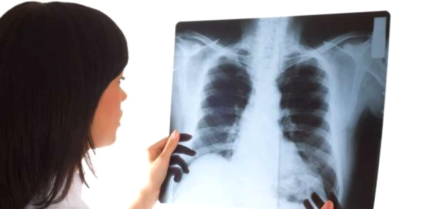 Radiografia poate indica prezenţa unor modificări canceroase la nivelul plămânilor