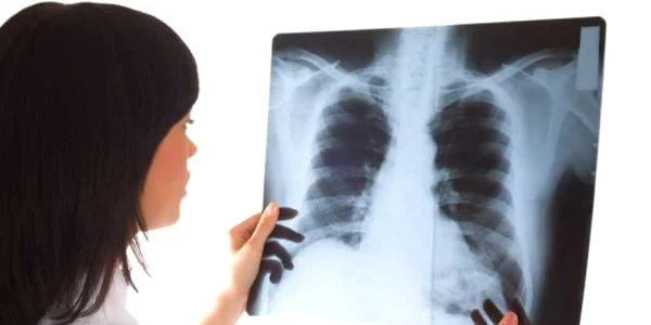 Radiografia poate indica prezenţa unor modificări canceroase la nivelul plămânilor