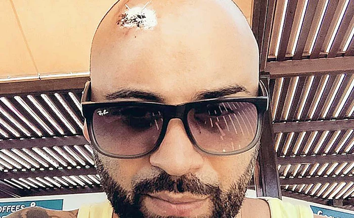 
    Matteo s-a ales  cu șase copci  