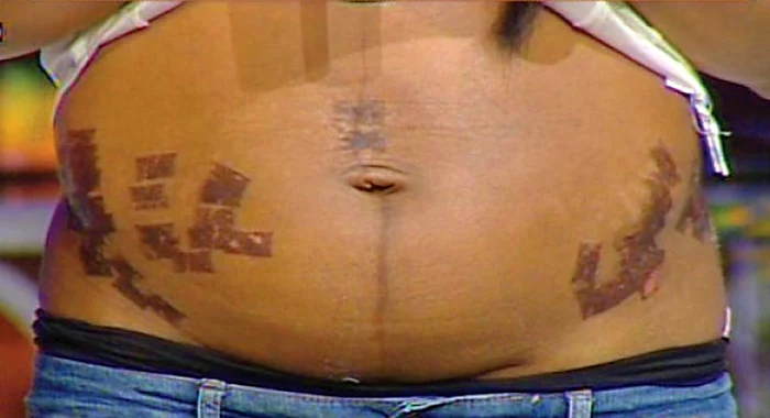 Laurette a apelat la un tratament de îndepărtare a vergeturilor