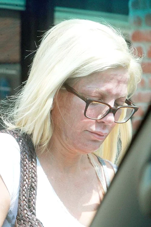 Recent şi-a distrus faţa cu tratamente cosmeticeFoto: Guliver Getty Images