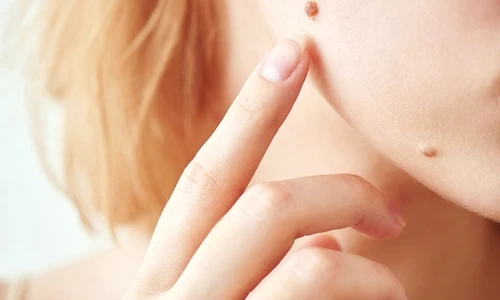 Identifică aluniţele periculoase dintr o singură privire jpeg