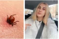 adda borelioza jpg