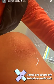 Adina Buzatu e plină de julituri Sursa Instagram 