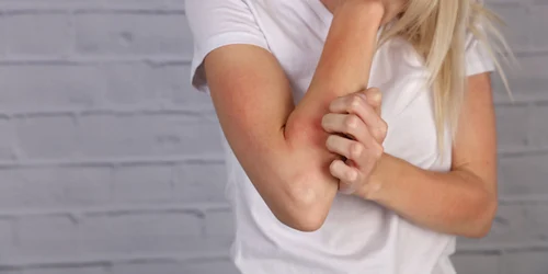 Femeie care se scarpina - mâncărime FOTO Shutterstock 